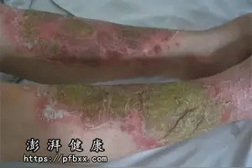 银屑病快好了但是皮肤很硬发黑很粗糙还脱皮是快好了吗图片
