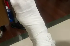 骨折第20天，我自己拆掉了石膏图片