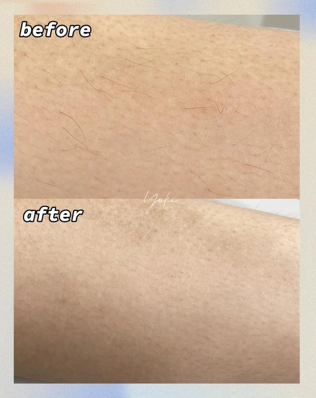 冰点脱毛以后可以擦身体乳吗