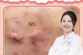 脸上长硬块痘痘，消不下去又挤不出来，怎么办？#痘痘 #医学科普 #去痘 #皮肤 