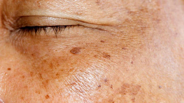 吉米护肤：这些长斑因素你不知道，还谈何淡斑？
