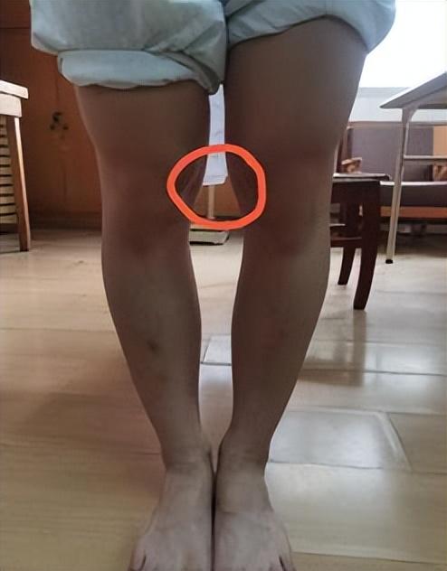成人矫正o型腿的矫正方法有哪些（夏天来了不敢露腿）