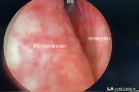 前列腺增生手术能不能做？手术并发症都有哪些？哪些可以避免？图片