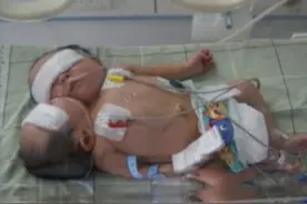 2011年，四川孕妇生下中国首例“双头宝宝”，最后怎么样了？图片