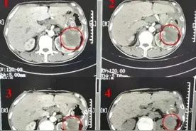 PNAS：发烧或能协助抗肿瘤，靠升高体温，杀死肿瘤靠谱吗？图片