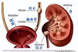千万别得尿结石，比生娃还痛！图片