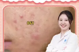 皮肤祛痘药膏合集，收藏转发，就讲这一回！#医学科普 #痘痘 #去痘 #皮肤 