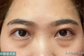 外切祛眼袋术后一个月高清恢复过程，42岁女士外切祛眼袋图片