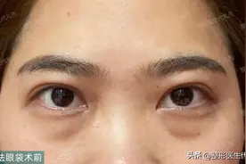 外切祛眼袋术后一个月高清恢复过程，42岁女士外切祛眼袋图片