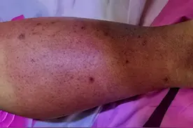 下肢红肿热痛？小心惹“毒”上身图片