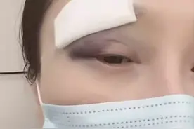 35岁女演员突发意外脸毁容，左眼青紫缝9针好吓人！自曝想退圈？图片