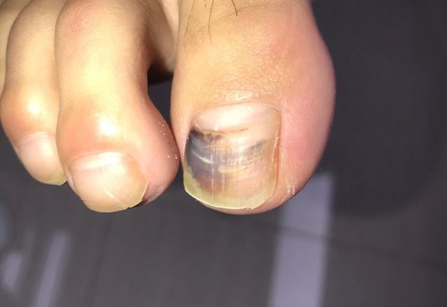 宝宝口腔白色角化株