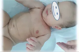 【绿色治疗】痒！皮肤问题！省儿童医院臭氧水疗来帮忙图片