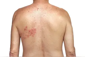 有一种剧痛叫“带状疱疹”，用什么药好得快？教你3招对付它图片
