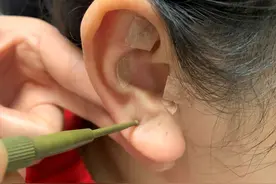 小小耳穴隐藏着心身健康秘密！助您脱掉“羊”皮，冲出“羊”圈图片