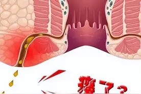 肛瘘为什么会被叫做“老鼠打洞”？图片