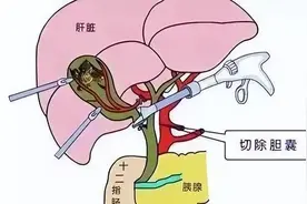 假如切除“胆囊”，会有后遗症呢？医生终于说出大实话图片