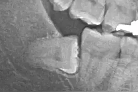 阻生智齿，非拔不可-说下痛苦的拔牙经历图片