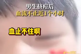 男生挤痘血流不止近1小时，当事人：用了400张抽纸，整个脸都苍白了；专家：自行挤压容易造成严重感染图片