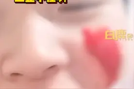 男生挤痘血流不止近1小时，当事人：用了400张抽纸，整个脸都苍白了；专家：自行挤压容易造成严重感染图片