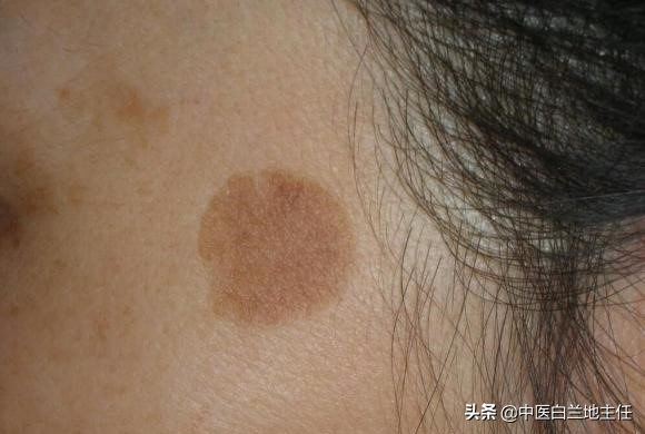 脂溢性角化症是老年斑吗