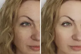 整形手术有后遗症？这些问题多半被坑了图片