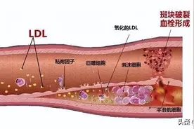 依折麦布降脂效果怎么样，长期服用需要注意哪些事项？图片