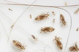 小时候头上长虱子是怎么回事？虱子又分别有哪几种？图片