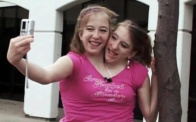 连体人是如何形成的?如果其中一个死亡,另外一个还能活下来吗?