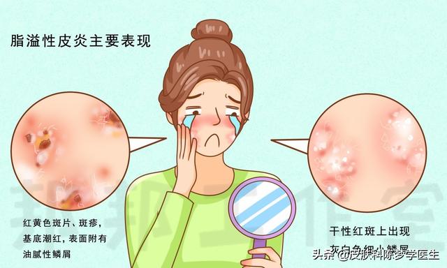 脸皮质角化