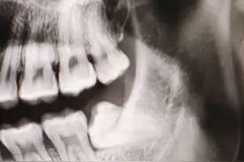 分享一下自己去华西拔智齿的经历，供大家参考图片