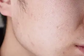 小小黑痣，也会是生命“关机键”？三个部位有黑痣，别不当回事图片