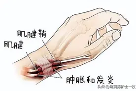临床手腕部腱鞘炎的诊疗措施图片