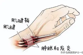 临床手腕部腱鞘炎的诊疗措施图片