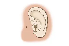 【爱耳日系列科普之耳前瘘管】耳前有个孔，该怎么办图片