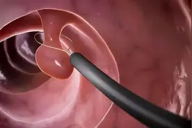 大便“前头干硬，后边软粘”是咋回事呢？医生：或与三种疾病有关图片