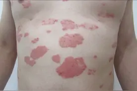 中医上把银屑病分为6种，你属于哪一种？图片