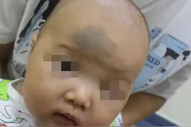 郑州市第二中医院陈婷婷主任：新生儿青色胎记怎么治疗？图片