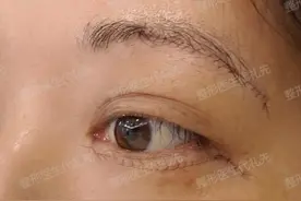 关于眼袋眶隔脂肪释放的10个问题，有眼袋泪沟的姐妹提前看看图片