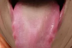 新冠五个疑难退烧案心得，这类高烧发不出汗！怎么办图片