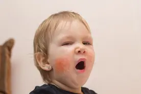 孩子湿疹严重怎么办？宝妈一年半护理经验告诉你怎么做图片