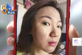 多了一脸红疹 想到胶原蛋白图片
