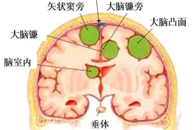 大叔突然失明，竟是它在作祟！专家说：要警惕这些症状......图片