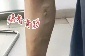 这病让你双腿爬满“蚯蚓”，任何人都可能被盯上！图片