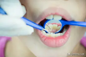 牙缝里的牙结石，如何清除干净？医生：3个办法是不少人的选择图片