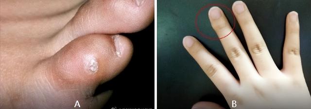 鸡眼刚长出来的样子鸡眼刚开始长什么样7（看图）