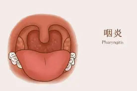 医生揭秘缓解扁桃体炎症状的三个方法！图片