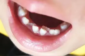旧牙未脱落新牙就萌出，当孩子长出“双排牙”，家长的做法很重要图片