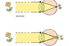 除了近视，你可能还需要了解散光和斜视！图片