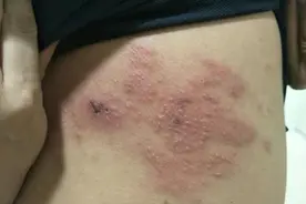 带状疱疹如何治疗？中医3个方子清泻肝经湿热，快速结痂消除疼痛图片